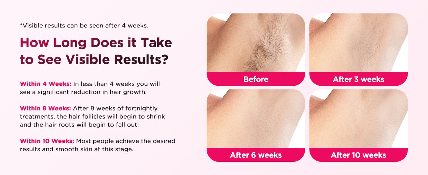 Épilateur laser IPL avec refroidissement par glace