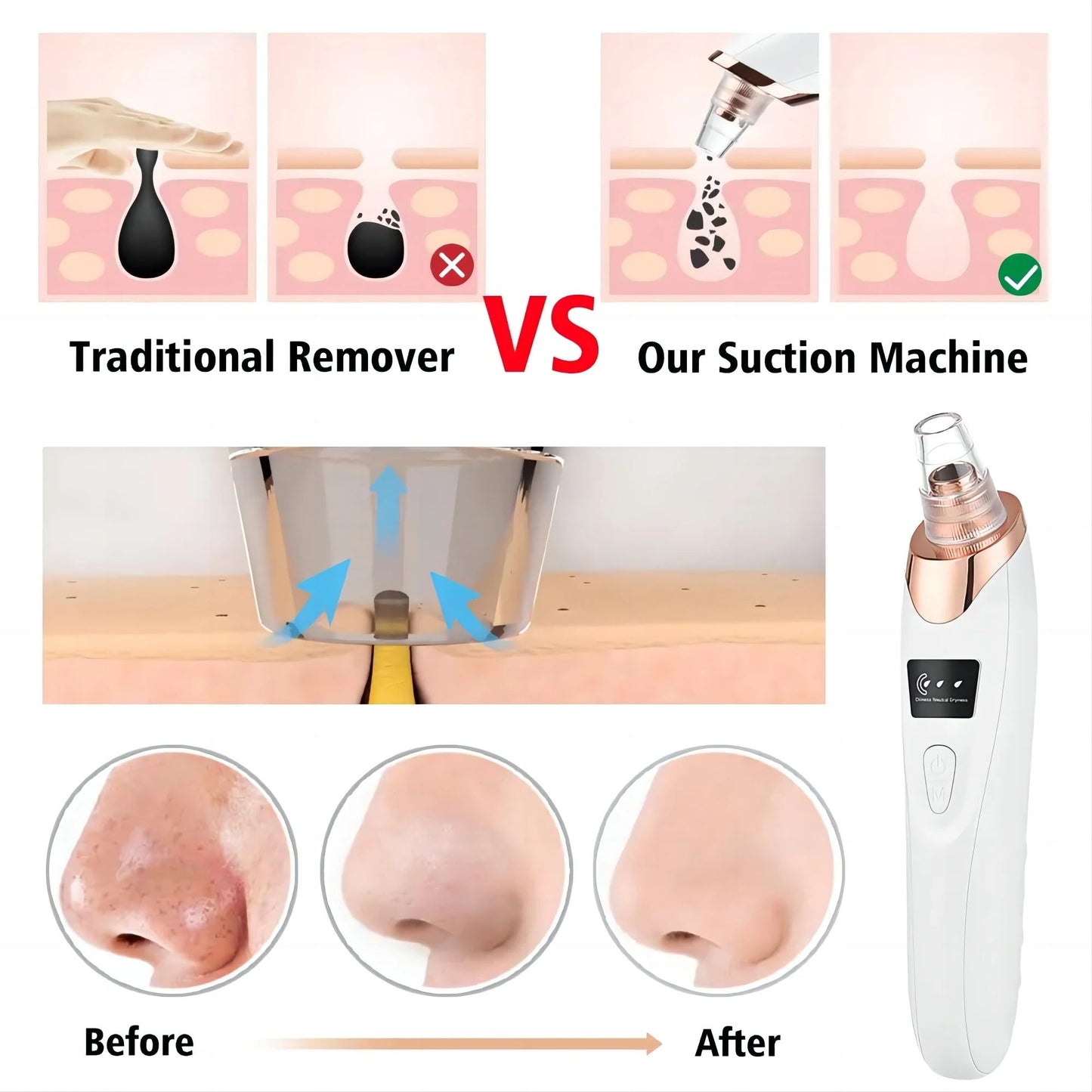 Microdermabrasion facial - Techni Tendresse