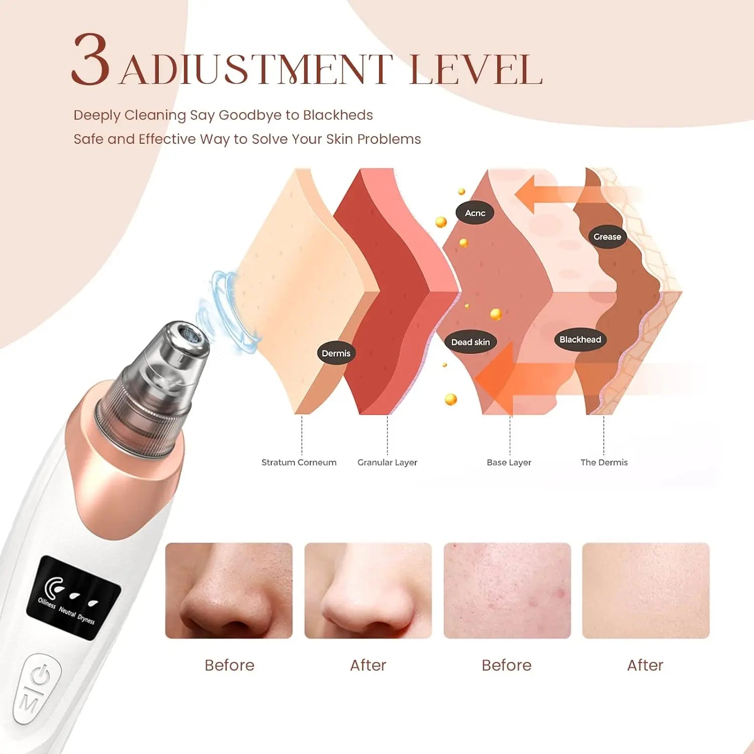 Microdermabrasion facial - Techni Tendresse